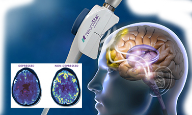 NeuroStar wand and brain image.