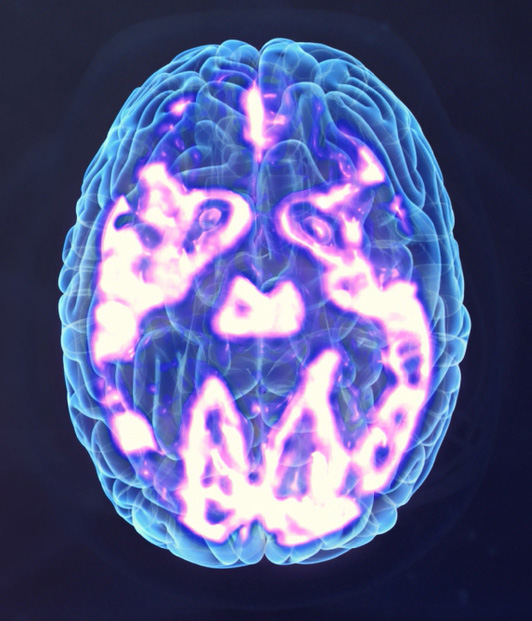 Brain image after TMS, shows highlighted areas indicating healthy brain function.