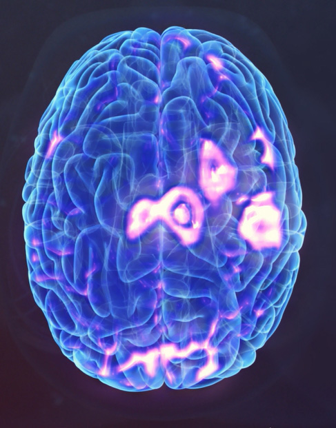 Brain Image before TMS shows dark ares where brain cells are not functioning normally.